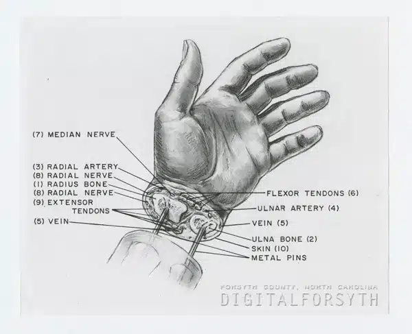 In 1965, a surgical team headed by Dr. Jesse Meredith at the Bowman Gray School of Medicine performed what is thought to be the first successful hand/wrist re-implantation in the United States. The dramatic eight-hour operation began 90 minutes after the left hand of 26-year-old Robert Pennell was accidentally amputated at the wrist on June 14, 1965 by a single blow of a bush ax. This illustration, by George Lynch, Professor and Director of the Department of Medical Illustration, shows how the severed hand was reattached. The numbers indicate the order in which the operation was performed.